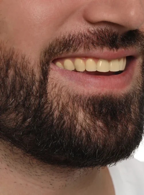 Antes: Casos de Clareamento