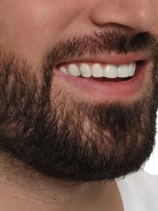 Depois: Casos de Clareamento